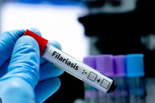 Over 62,000 to receive elephantiasis, river blindness drugs in Awerial County