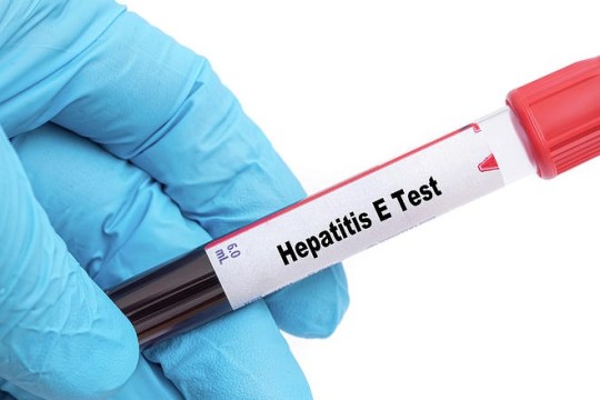 Abyei records 40 cases of Hepatitis E