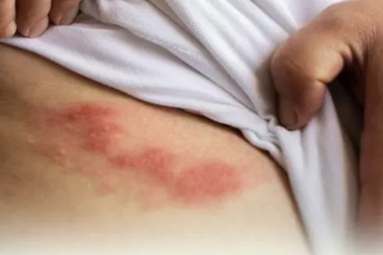 New awareness campaigns on shingles launched in alignment with World Immunization Week-Bahrain