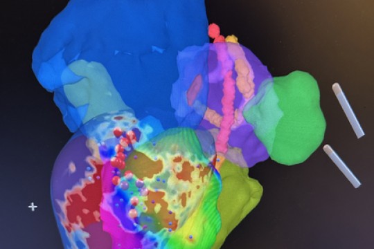 أول عملية استئصال عضلة القلب البطينية الإقفارية البشرية بنجاح في iCMR